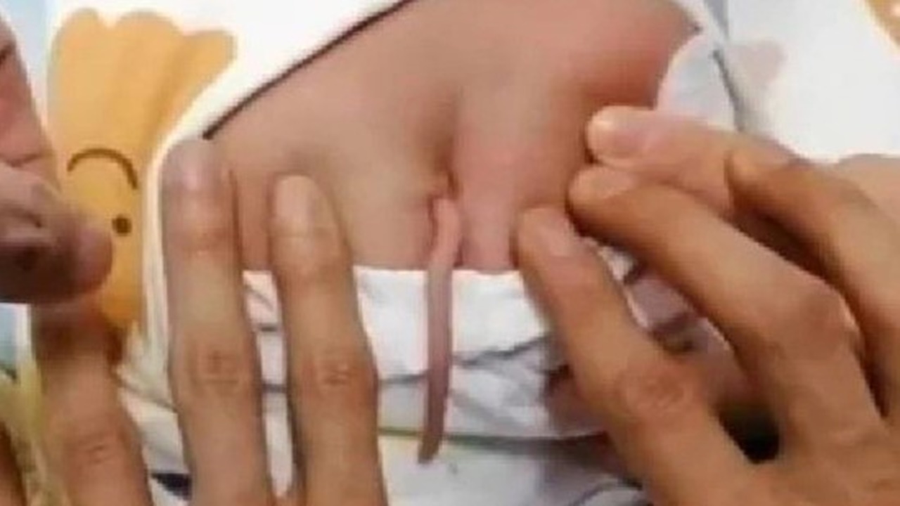 Kuyruklu bebek şoku doktorları harekete geçirdi! Gördüklerine inanamadılar