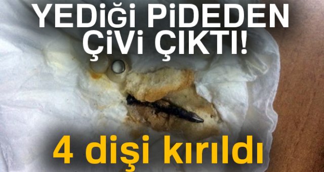 Pideden çıkan çivi 4 dişini kırdı